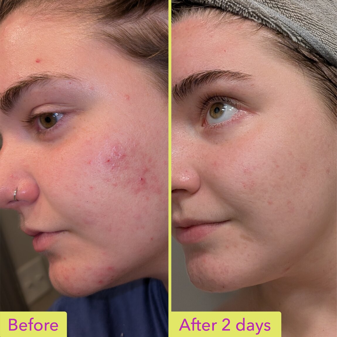 Good Molecules 10% Azelaic Acid Treatment 30ml - View 3